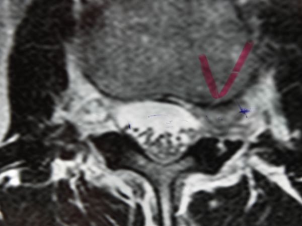 MRI-herniated disc